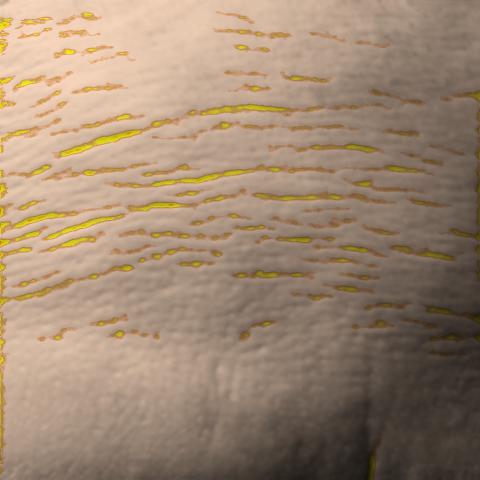 Antera 3D image of forehead lines, baseline