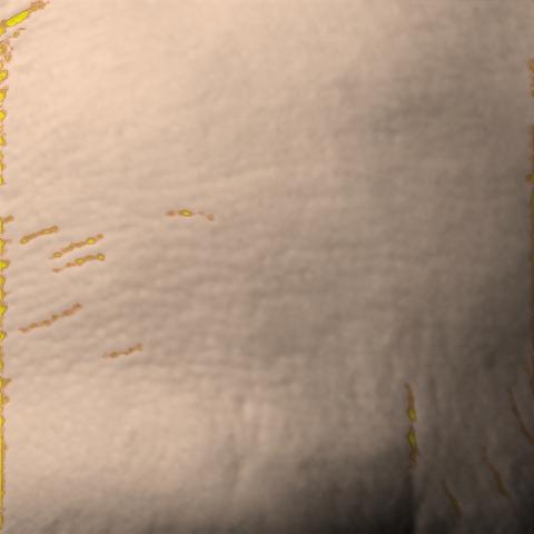 Antera 3D image of forehead lines, day 28