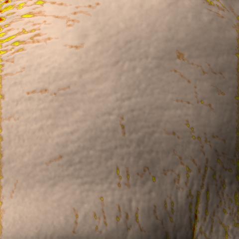 Antera 3D image of forehead lines, day 42