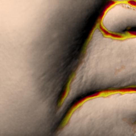 Antera 3D image of nasolabial folds, baseline