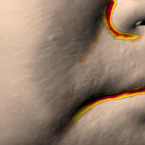 Antera 3D image of nasolabial folds, day 14