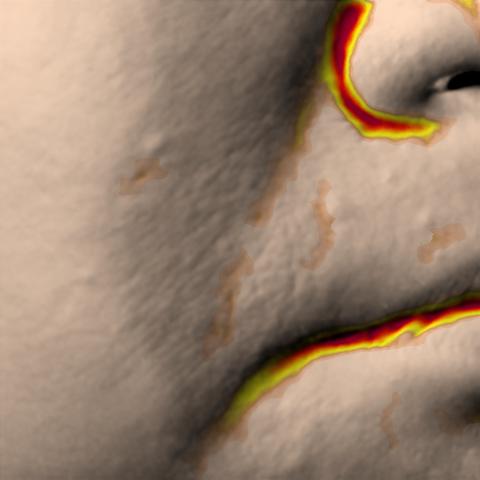 Antera 3D image of nasolabial folds, day 42